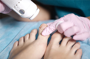 hyperblue laser therapy