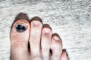 Causes and Symptoms of Runner’s Toe
