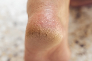 Cracked Heels and Podiatry Care