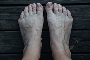Causes and Treatment of Bunionettes