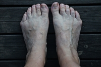 Causes and Treatment of Bunionettes