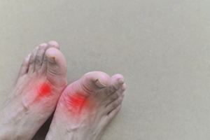 Avoiding Flare-Ups From Gout in the Feet
